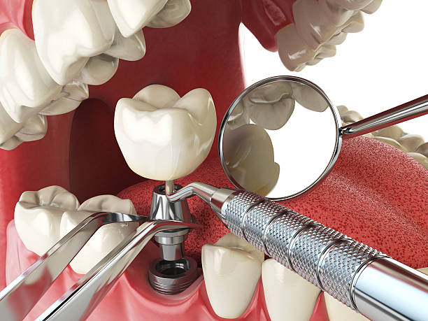 Best Emergency Tooth Extraction in Harrington, DE